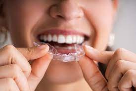 Clear Aligners: What You Need to Know Before Starting Treatment
