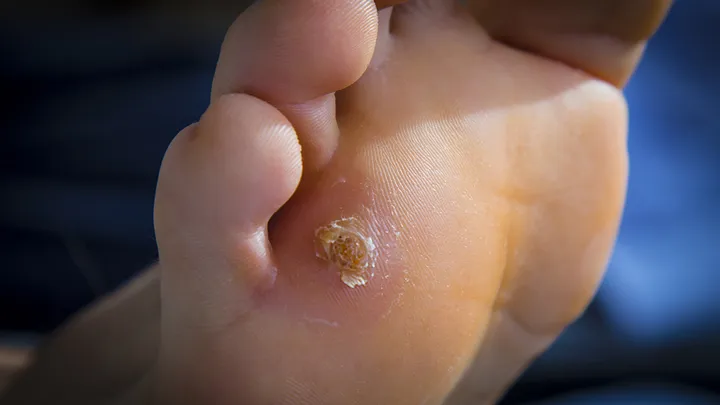 Top 5 Common Foot Conditions and How to Treat Them