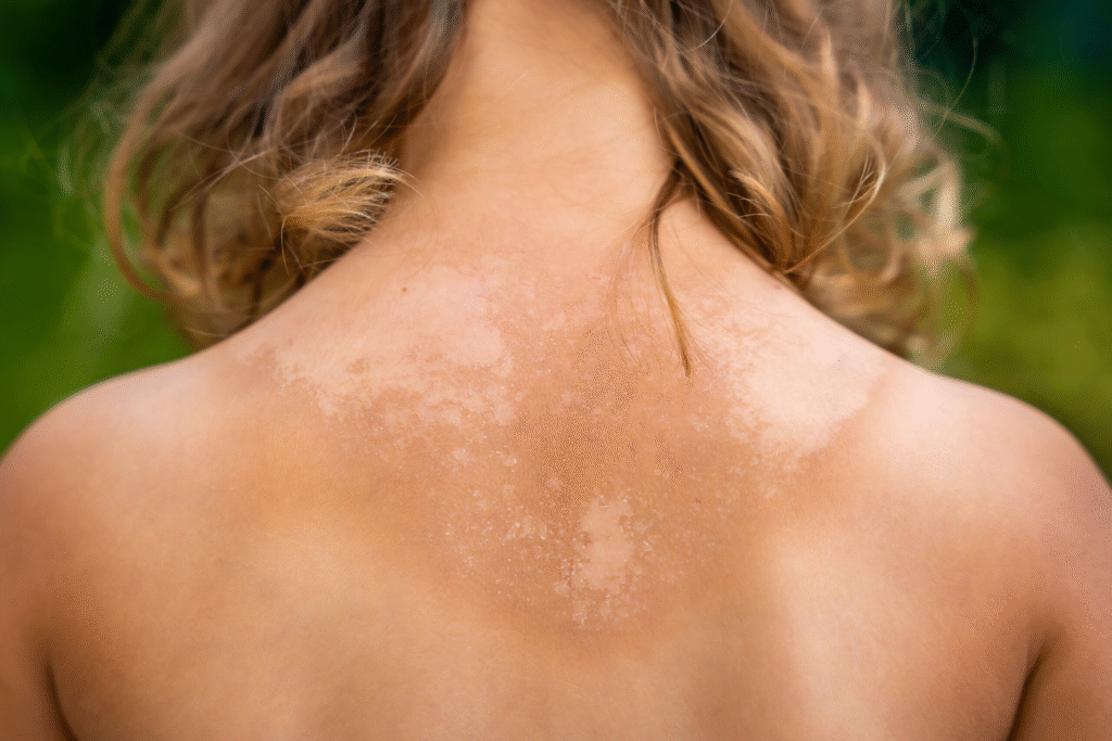 How to Treat Sunburn Quickly and Effectively