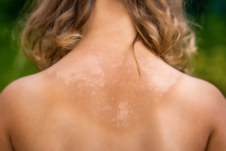 How to Treat Sunburn Quickly and Effectively