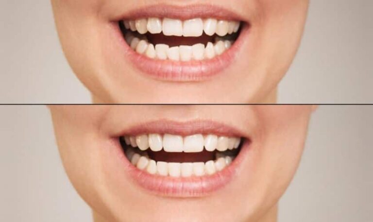 Can Veneers Help with Misaligned Teeth?