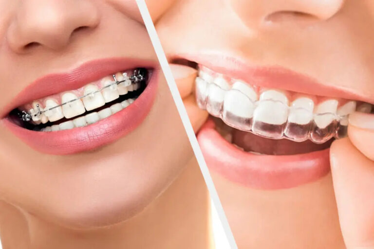 How Retainers Keep Your Teeth in Place After Braces Treatment