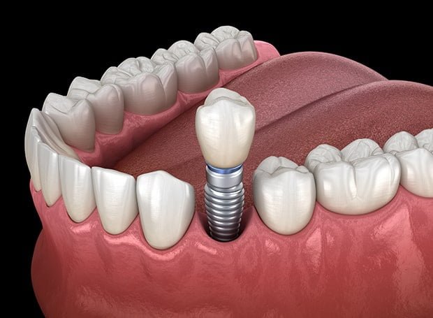 What Are the Best Aftercare Tips for Dental Implants?