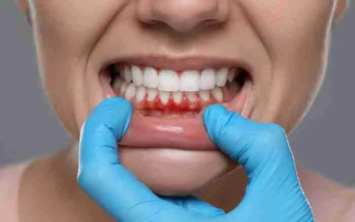 4 Early Signs of Gum Disease and How a Dentist Can Help