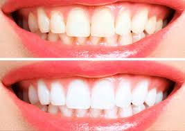 Achieving a Brighter Smile With Teeth Whitening