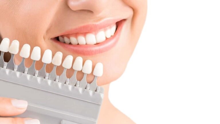 Choosing Between Veneers and Crowns