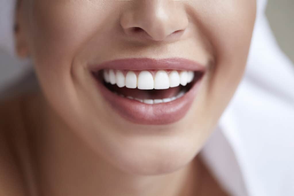 How Veneers Transform Your Smile Naturally
