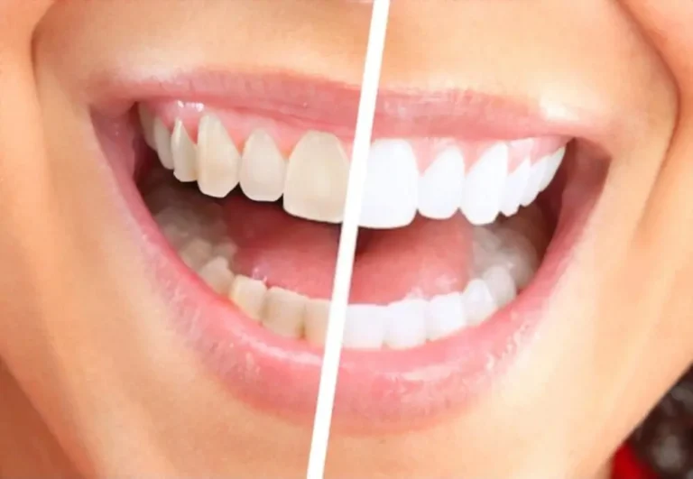 Teeth Whitening for a Bright and Confident Smile This Summer