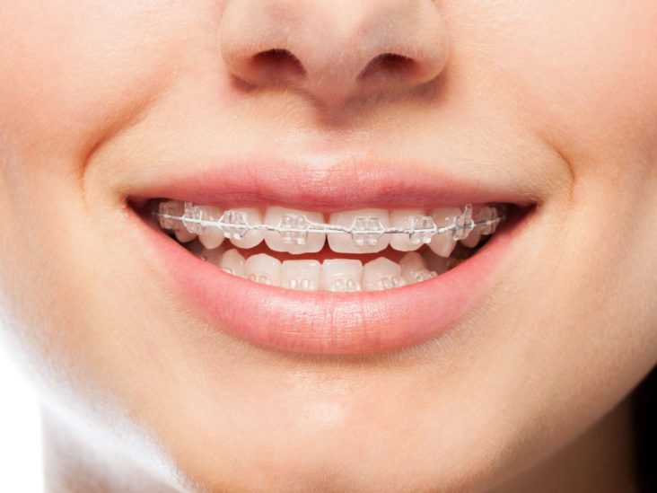 The Different Types of Braces for Every Smile