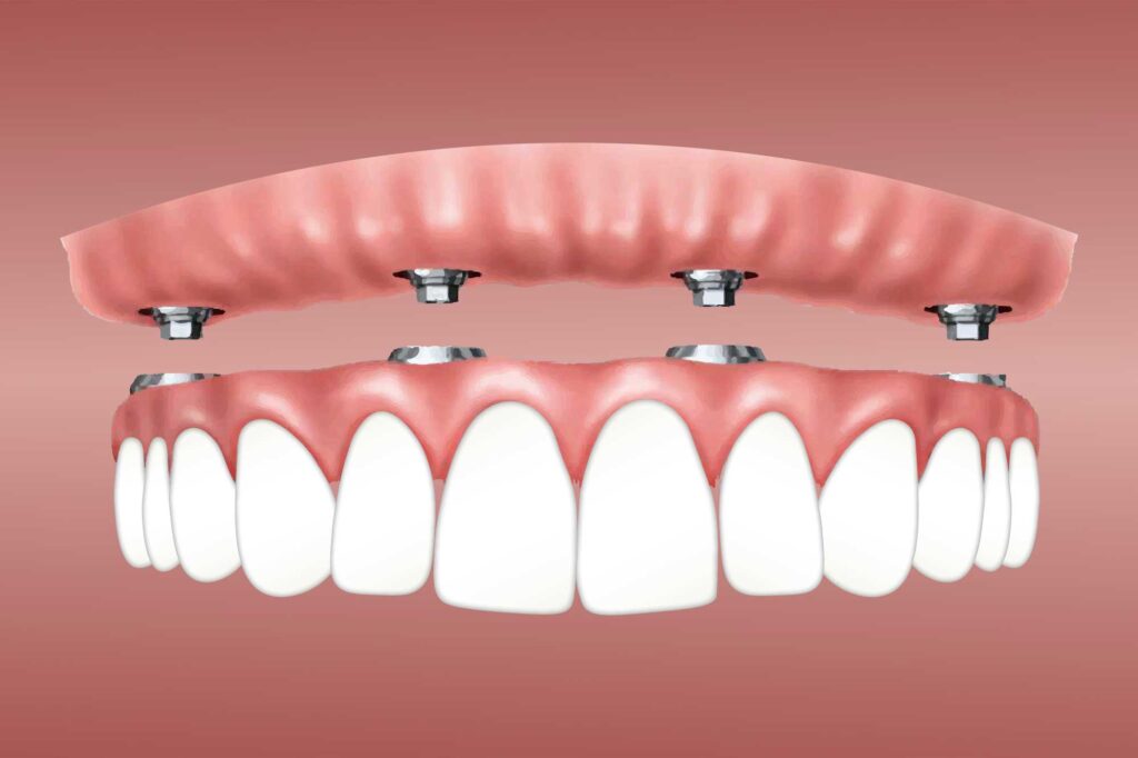 What You Need to Know About Dental Implants