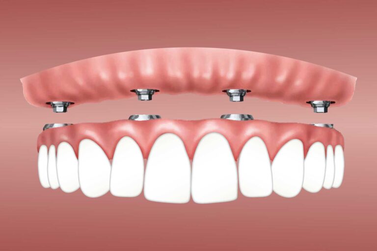 What You Need to Know About Dental Implants