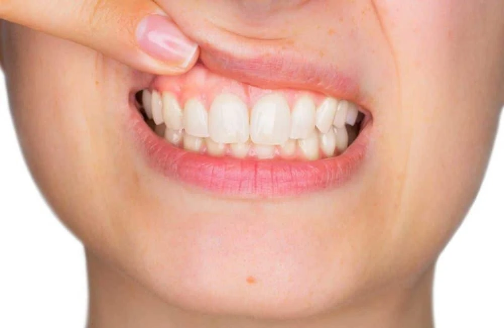 When Do You Need a Crown? Common Signs and Symptoms