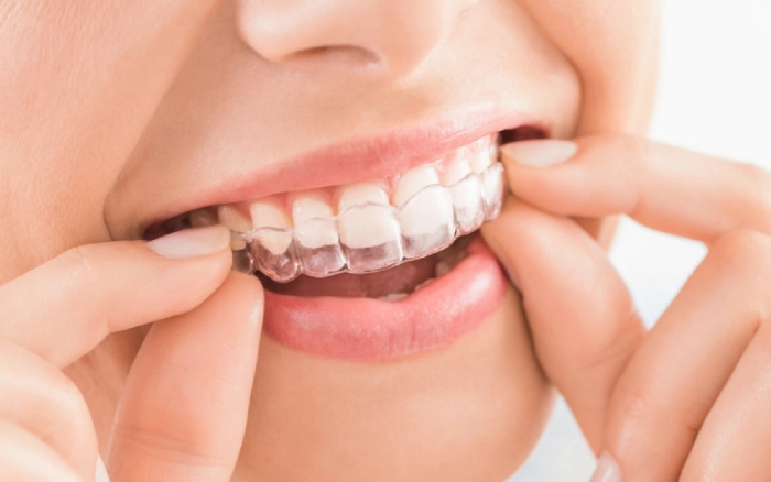 Why Invisalign Is a Beneficial Choice for Adults and Teens