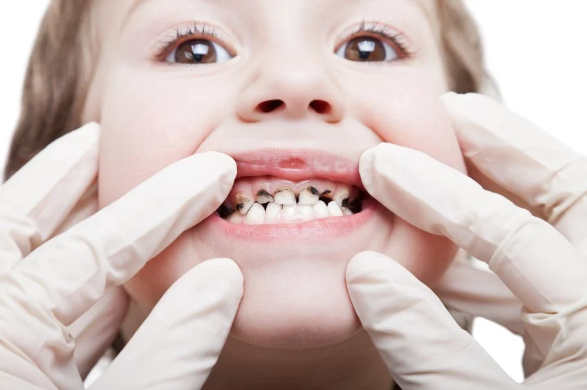 Why Sealants Are Beneficial for Children's Oral Health