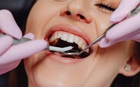 Understanding the Benefits and Process of Getting a Dental Bridge