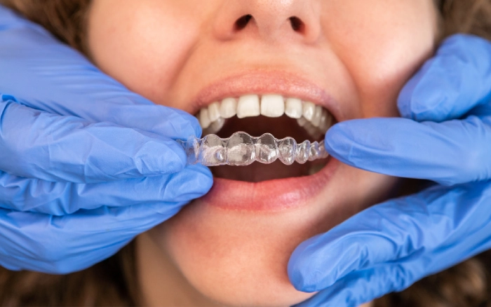 What Is the Invisalign Process?
