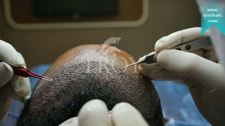 Long-term Care Tips After a Hair Transplant
