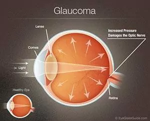 The Role of Family History in Glaucoma Risk Assessment