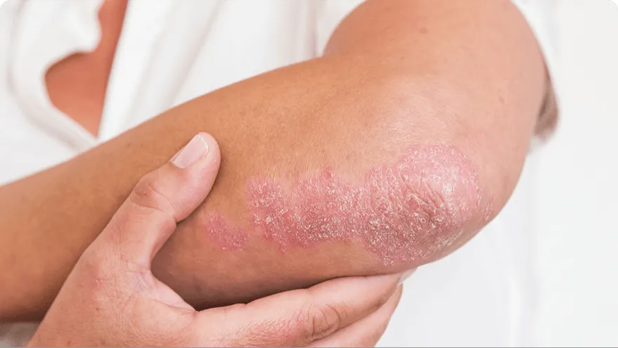 What Patients Should Know About the Latest Advances in Psoriasis Treatment