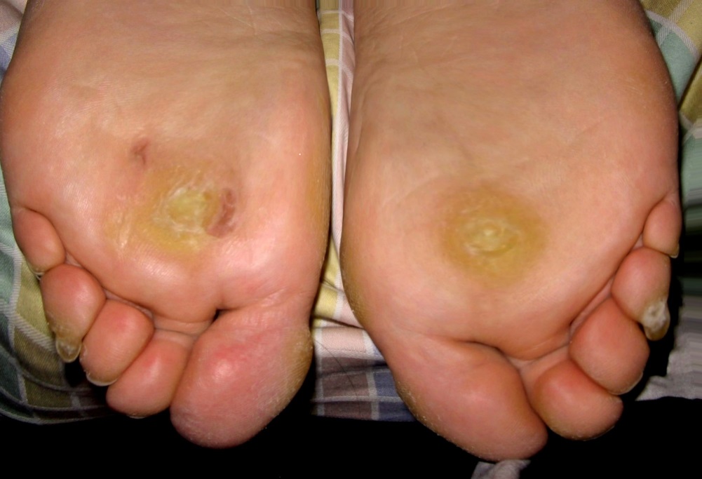Addressing Myths and Facts About Plantar Warts