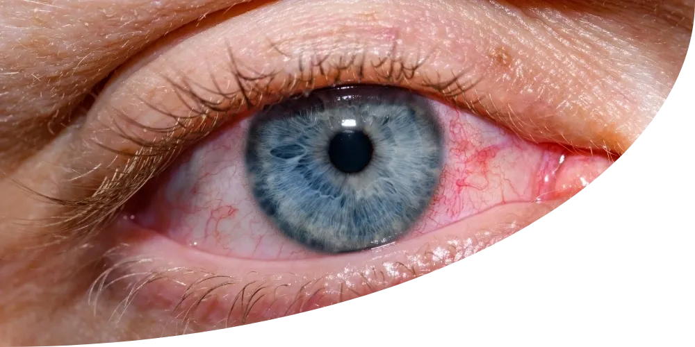 Exploring Causes and Treatment for Pink Eye in Adults