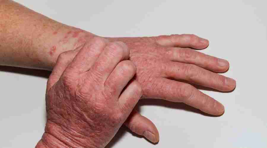 Helpful Tips for Managing Eczema in Children