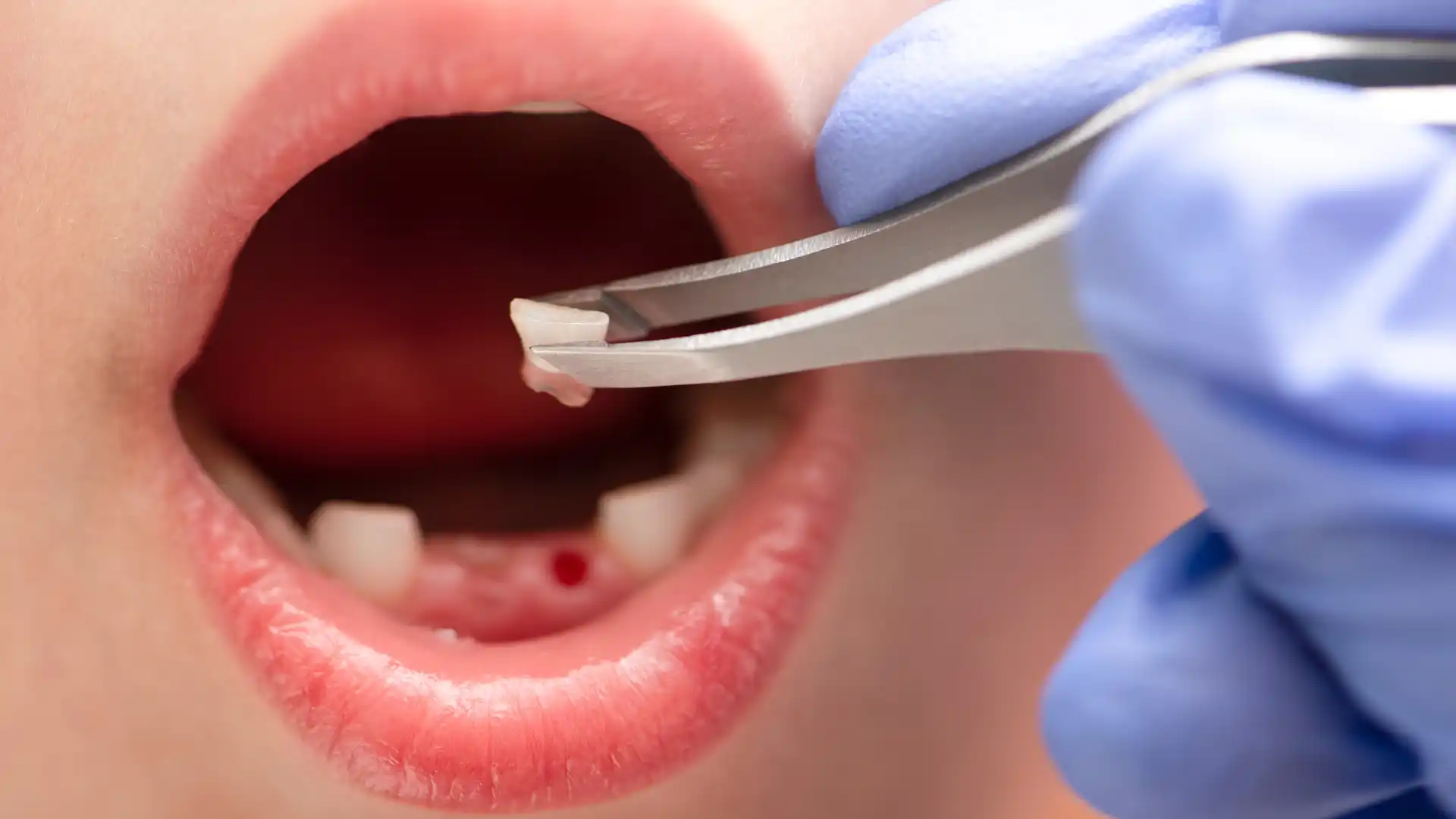 How To Prevent the Need for a Tooth Extraction