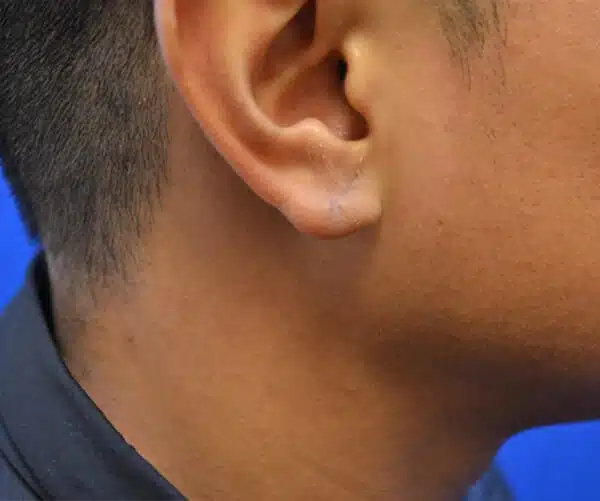 The Benefits of Professional Earlobe Repair