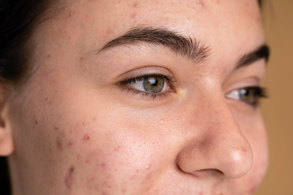 Tips for Treating Acne