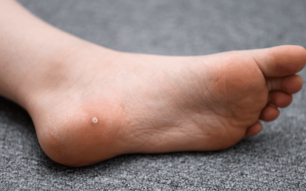 Understanding Causes, Symptoms, and Treatment Options for Plantar Warts