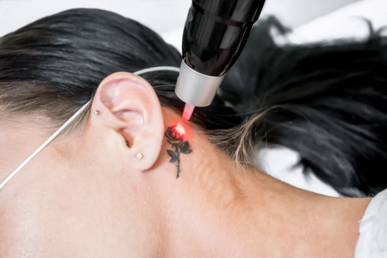 Understanding the Tattoo Removal Process and Its Effectiveness