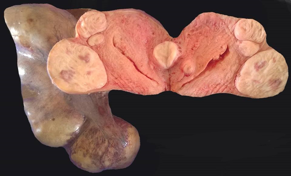 Understanding the Types of Fibroids and Their Symptoms