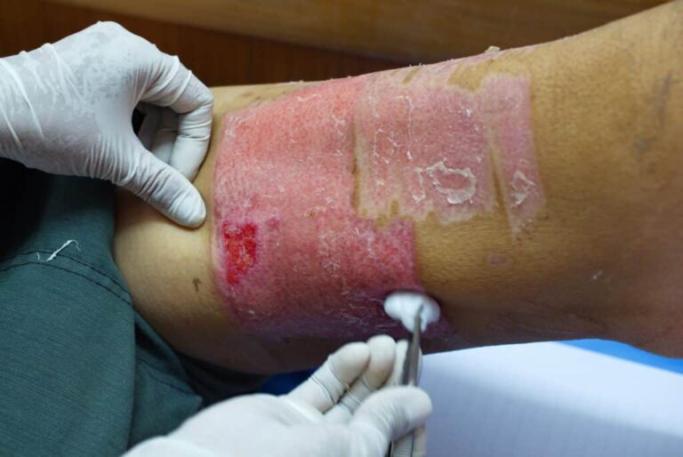 Effective Strategies for Managing Chronic Wounds