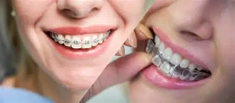 How Invisalign Differs From Traditional Braces