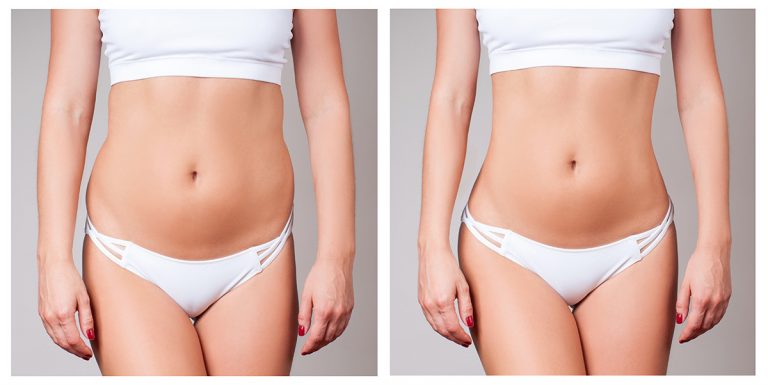 What to Expect from Excess Skin Removal Surgery After Weight Loss